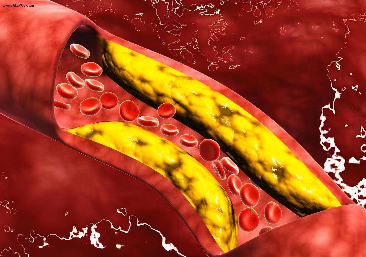 甘油三酯再思考：高甘油三酯血症是心血管疾病的必要治疗靶点吗？