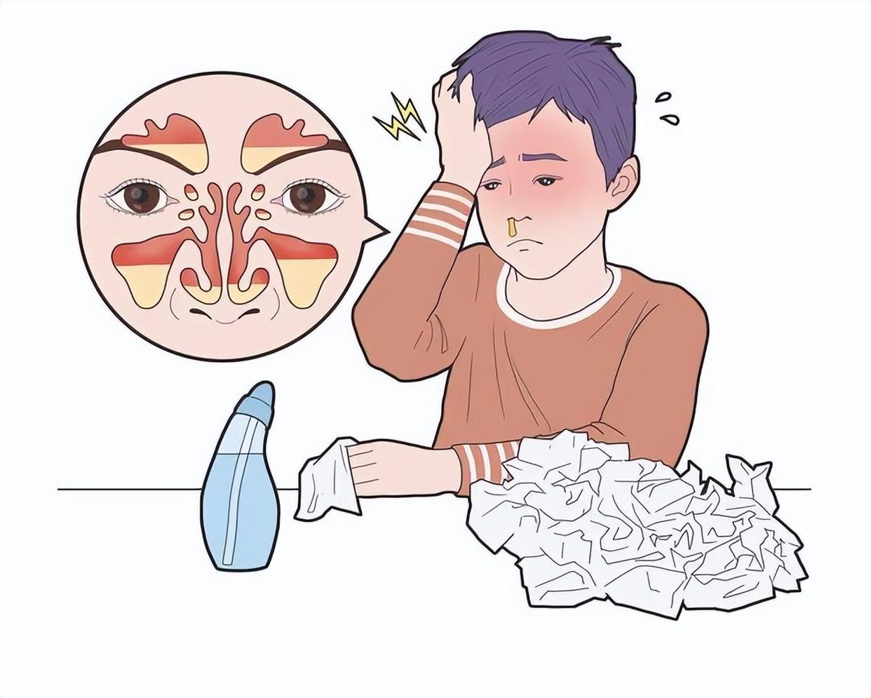 过敏性鼻炎用药大全，太实用了！